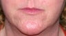 Vbeam for rosacea