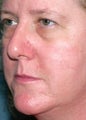 PDL for rosacea 