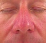 Vbeam for Rosacea Treatment