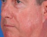 Vbeam laser rosacea treatment