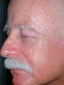 PDT for rosacea