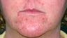 Vbeam for rosacea