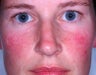 Laser treatment for rosacea 