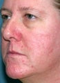 PDL for rosacea 