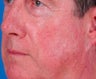 Vbeam laser rosacea treatment