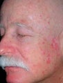 PDT for rosacea