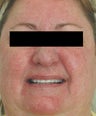 Rosacea Laser Treatment Los Angeles Before and After Pictures