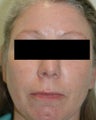 Laser Treatments for Rosacea