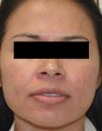 Rosacea Treatment with Lasers