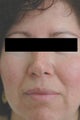 Laser Treatments for Rosacea