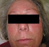 Laser Treatments for Rosacea