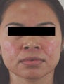 Rosacea Treatment with Lasers