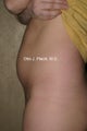 Liposuction of Mons Pubis