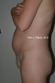 Liposuction of Mons Pubis