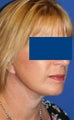Facelift for Female, 56