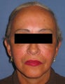 Facelift