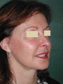 Female Facelift