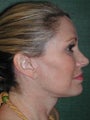 Female Facelift