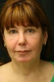 Facial Rejuvenation