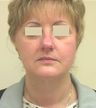 Face lift and neck lipoplasty
