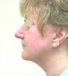 Facelift and Neck Lipoplasty