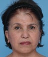 SMAS facelift and upper blepharoplasty