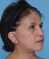 SMAS Facelift and Upper Eyelid Lift 