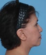 Upper Blepharoplasty and SMAS Facelift