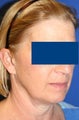 Facelift for Female, 56