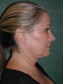 Female Facelift