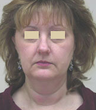 Face lift and neck lipoplasty
