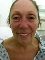 Facelift