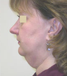 Facelift and Neck Lipoplasty
