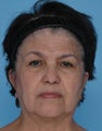 SMAS facelift and upper blepharoplasty
