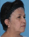 SMAS Facelift and Upper Eyelid Lift 