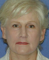 Facelift Surgery, Nasolabial Augmentation, Skin Resurfacing