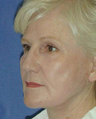 Facelift Surgery, Nasolabial Augmentation and Skin Resurfacing
