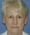 Facelift Surgery, Nasolabial Augmentation, Skin Resurfacing