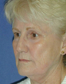 Facelift Surgery, Nasolabial Augmentation and Skin Resurfacing