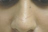 Scar Removal 