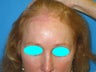53 Year Old Female previoulsy treated with skin graft after skin cancer removal