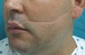 Scar Revision