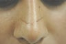 Scar Removal 
