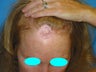 53 Year Old Female previoulsy treated with skin graft after skin cancer removal