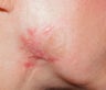 Vbeam for scar on jawline 