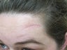Scar Removal by Fat Transfer