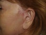 Scar and Earlobe Repair