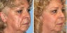 Scars Treatment