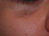 Scars Treatment
