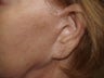Scar and Earlobe Repair